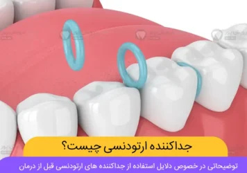 عکس جداکننده ارتودنسی دندان