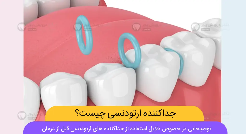 عکس جداکننده ارتودنسی دندان