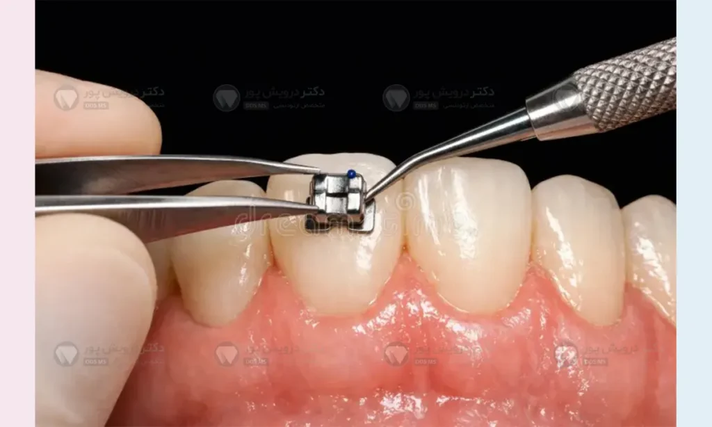 اتصال اولین براکت