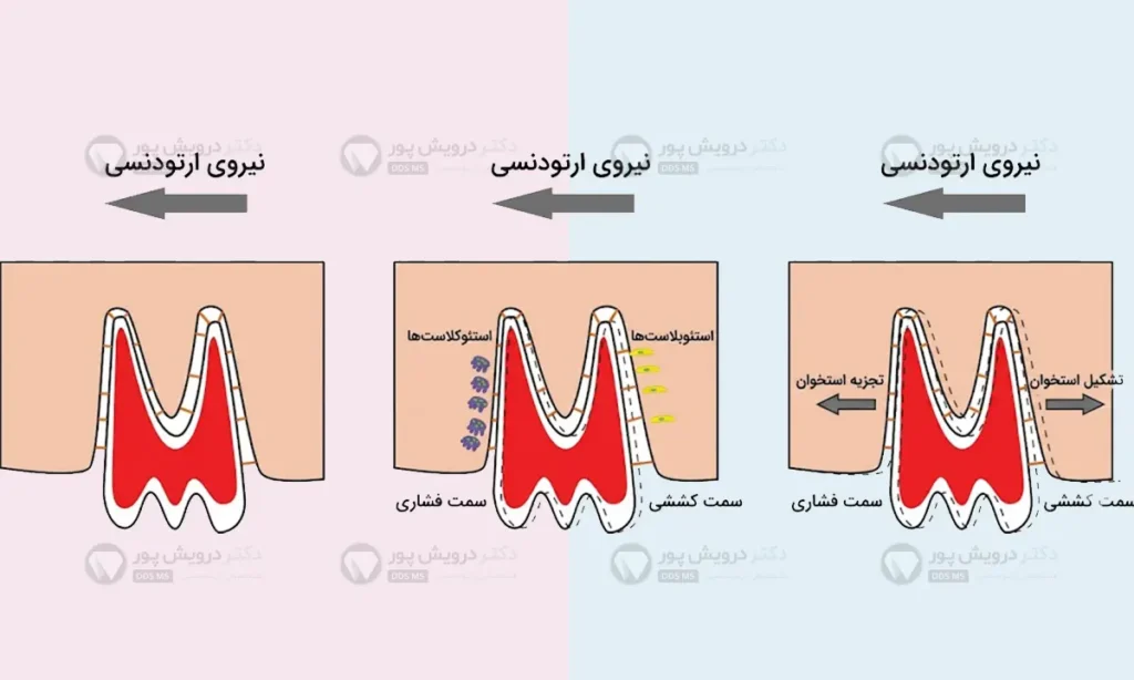 حرکت دندان در طول درمان ارتودنسی