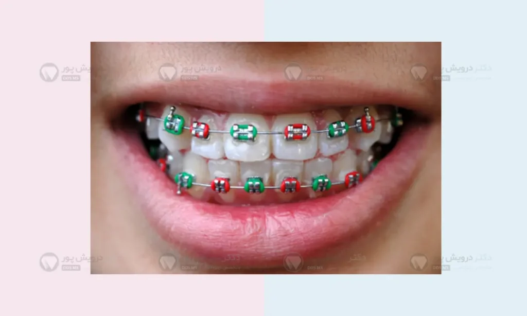 گیر غذایی اطراف براکت ها در طول ارتودنسی
