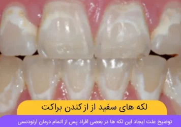 لکه های سفید بعد از برداشتن براکت شاخص