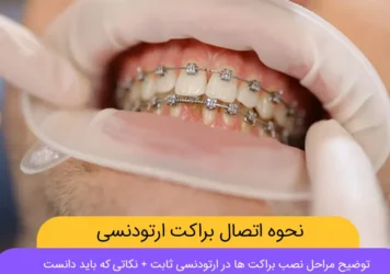 نحوه اتصال نحوه اتصال براکت به دندان شاخص