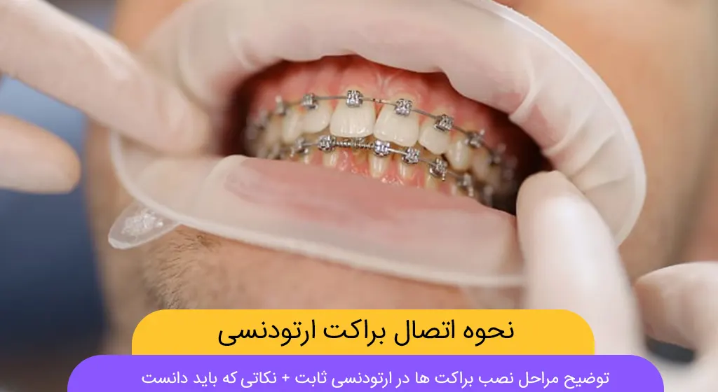 نحوه اتصال نحوه اتصال براکت به دندان شاخص