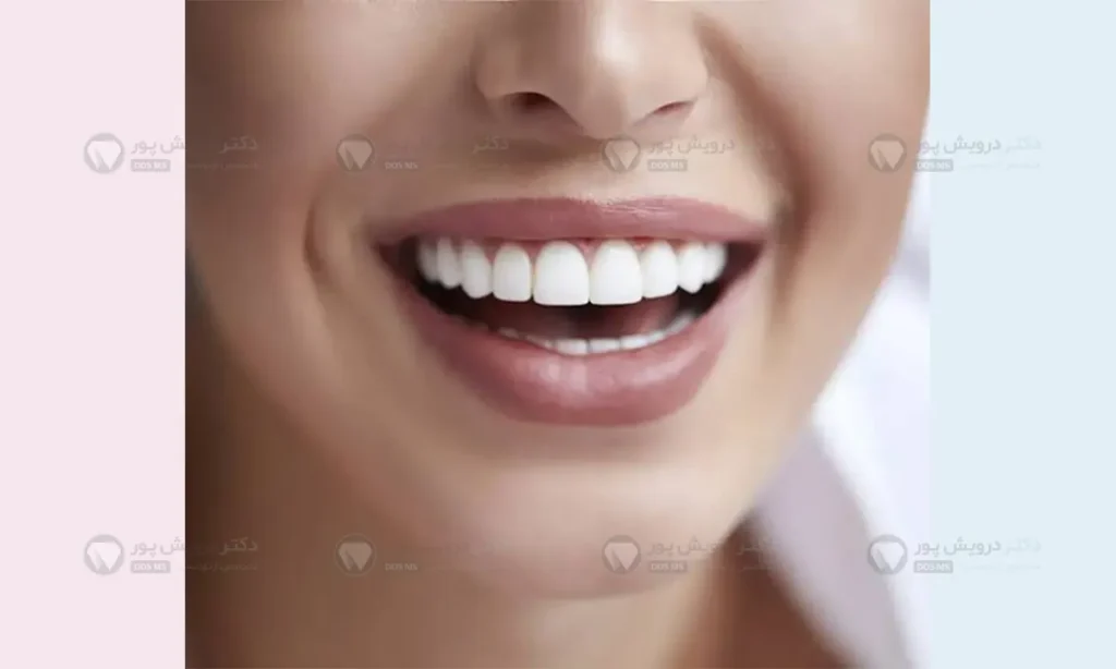 کامپوزیت دندان غیرطبیعی