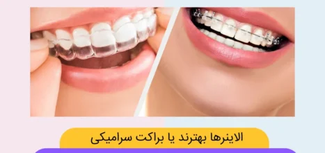 الاینرهای شفاف بهترند یا ارتودنسی سرامیکی شاخص