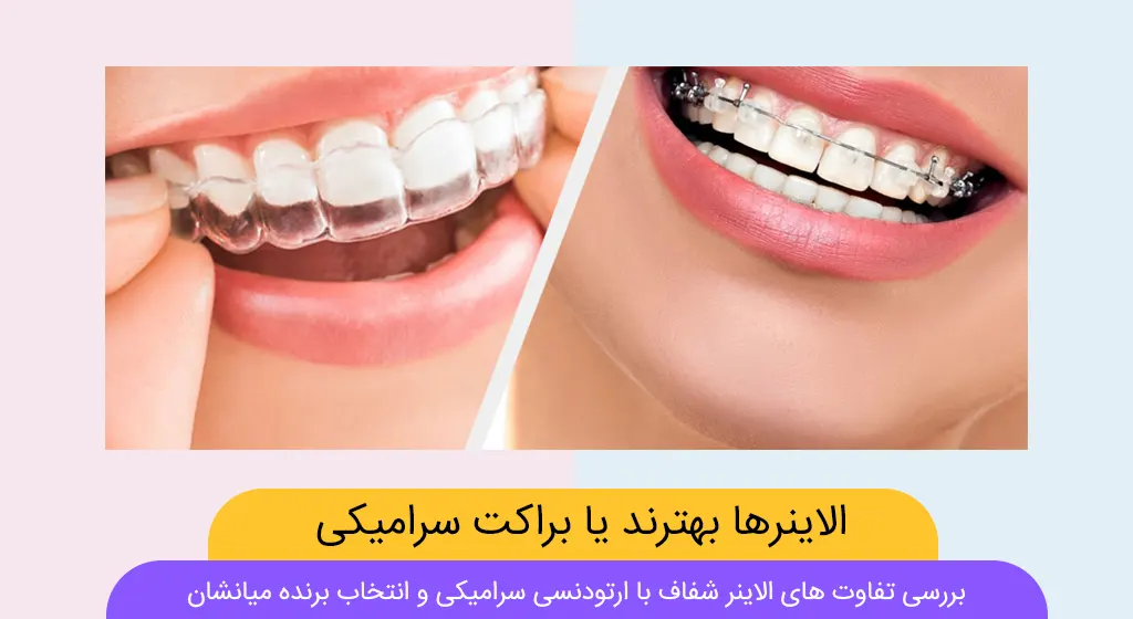 الاینرهای شفاف بهترند یا ارتودنسی سرامیکی شاخص