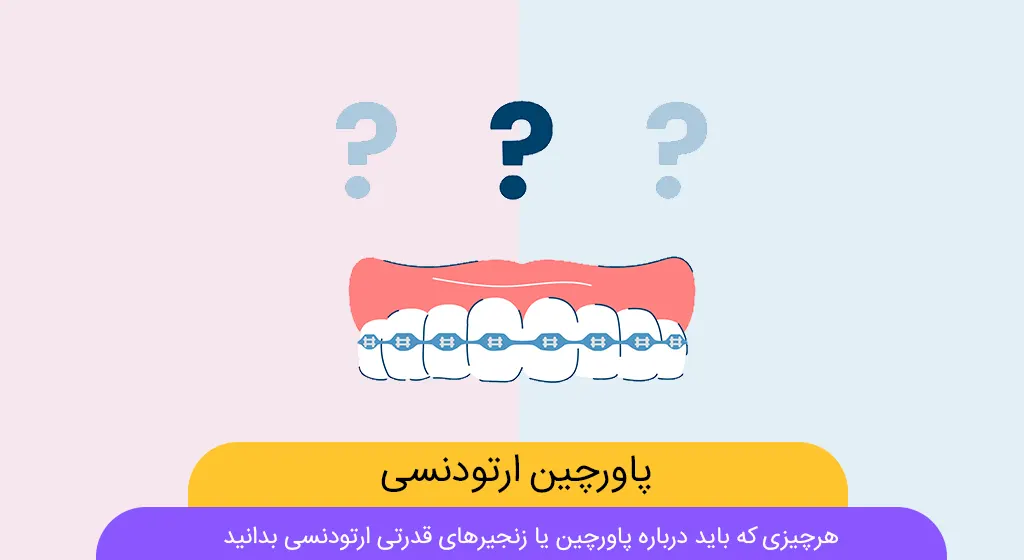 پاورچین ارتودنسی شاخص
