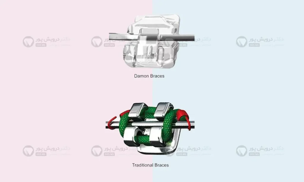 فرق ارتودنسی معمولی با دیمون