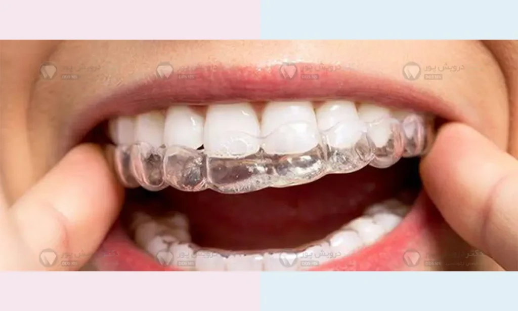 گذاشتن الاینر روی دندان ها