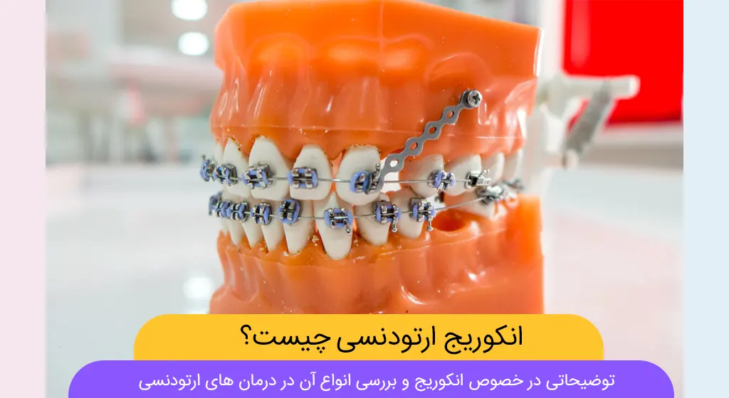 انکوریج ارتودنسی شاخص