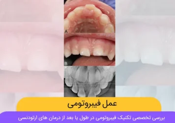 عمل فیبروتومی شاخص