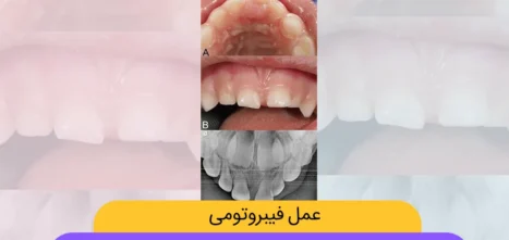 عمل فیبروتومی شاخص