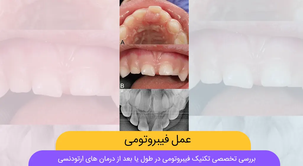 عمل فیبروتومی شاخص