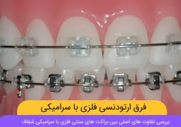 فرق ارتودنسی سرامیکی و فلزی