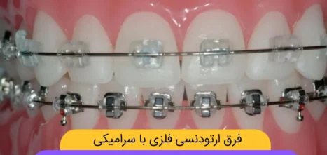 فرق ارتودنسی سرامیکی و فلزی