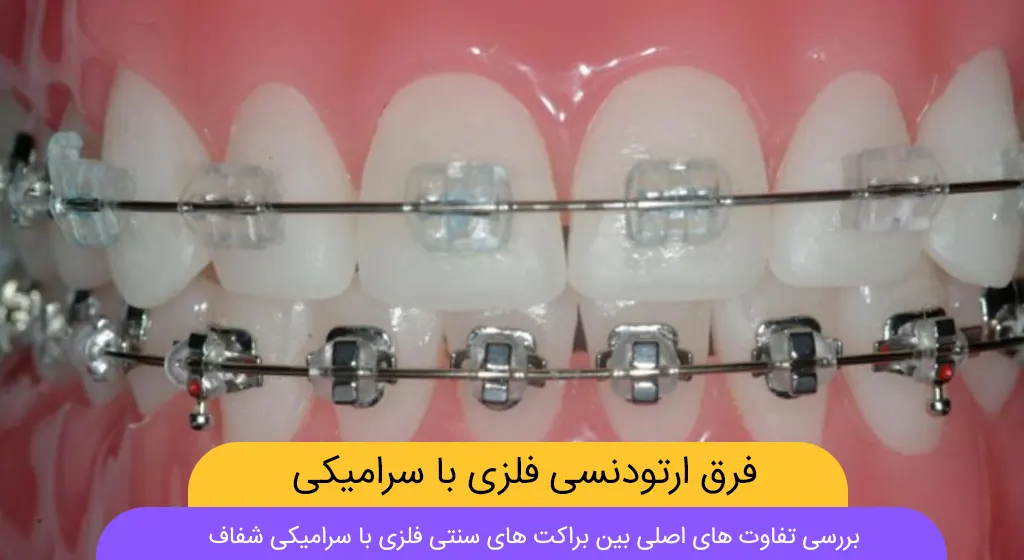فرق ارتودنسی سرامیکی و فلزی