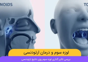 تاثیر لوزه سوم بر ارتودنسی شاخص