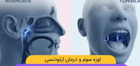 تاثیر لوزه سوم بر ارتودنسی شاخص