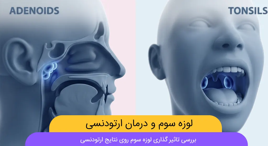 تاثیر لوزه سوم بر ارتودنسی شاخص