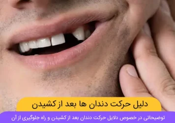حرکت دندان بعد از کشیدن شاخص