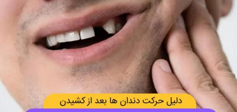 حرکت دندان بعد از کشیدن شاخص