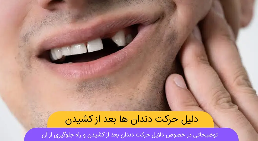 حرکت دندان بعد از کشیدن شاخص