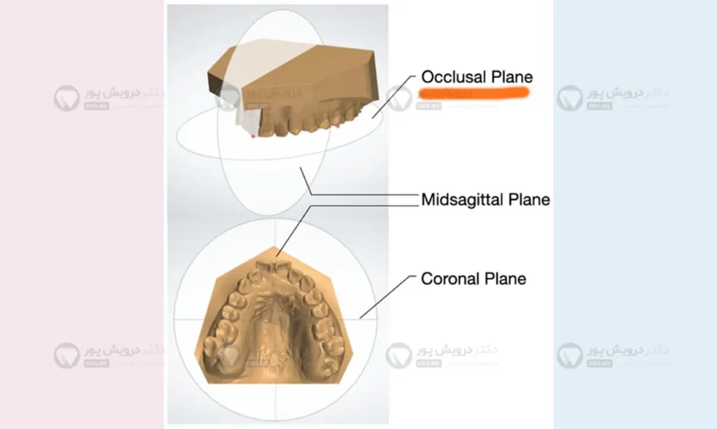 عکس پلان اکلوزال