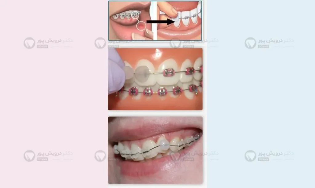 موم ارتودنسی