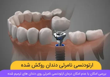 ارتودنسی نامرئی دندان روکش شده