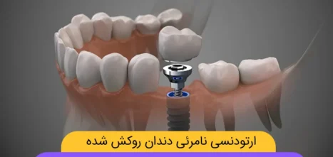 ارتودنسی نامرئی دندان روکش شده