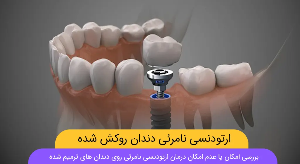 ارتودنسی نامرئی دندان روکش شده