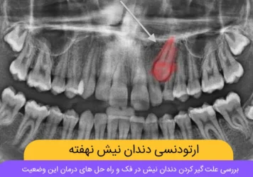 ارتودنسی دندان نیش نهفته شاخص
