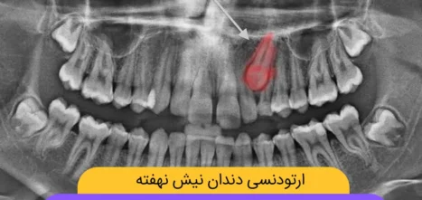 ارتودنسی دندان نیش نهفته شاخص