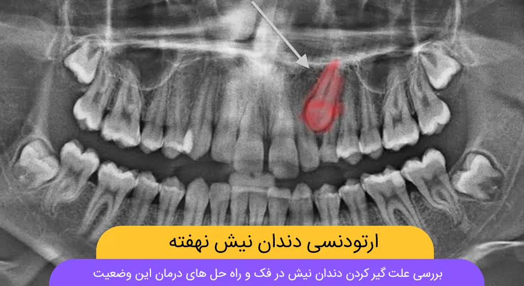 ارتودنسی دندان نیش نهفته شاخص