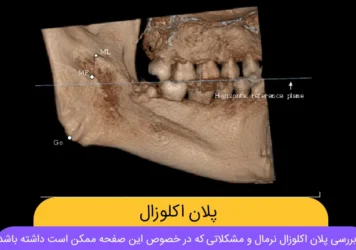 پلان اکلوزال شاخص