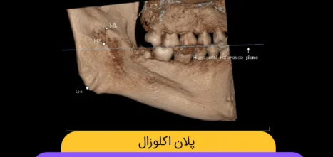 پلان اکلوزال شاخص