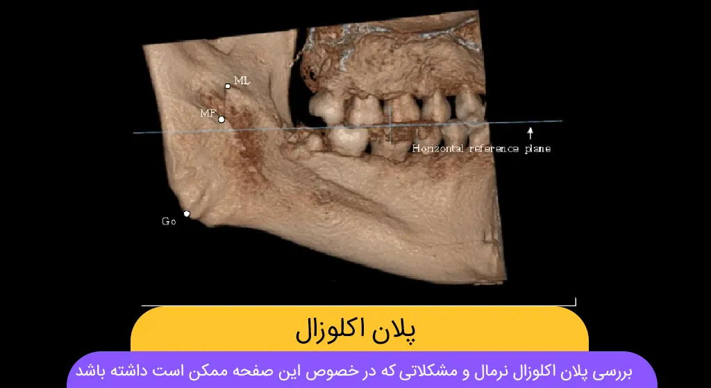پلان اکلوزال شاخص