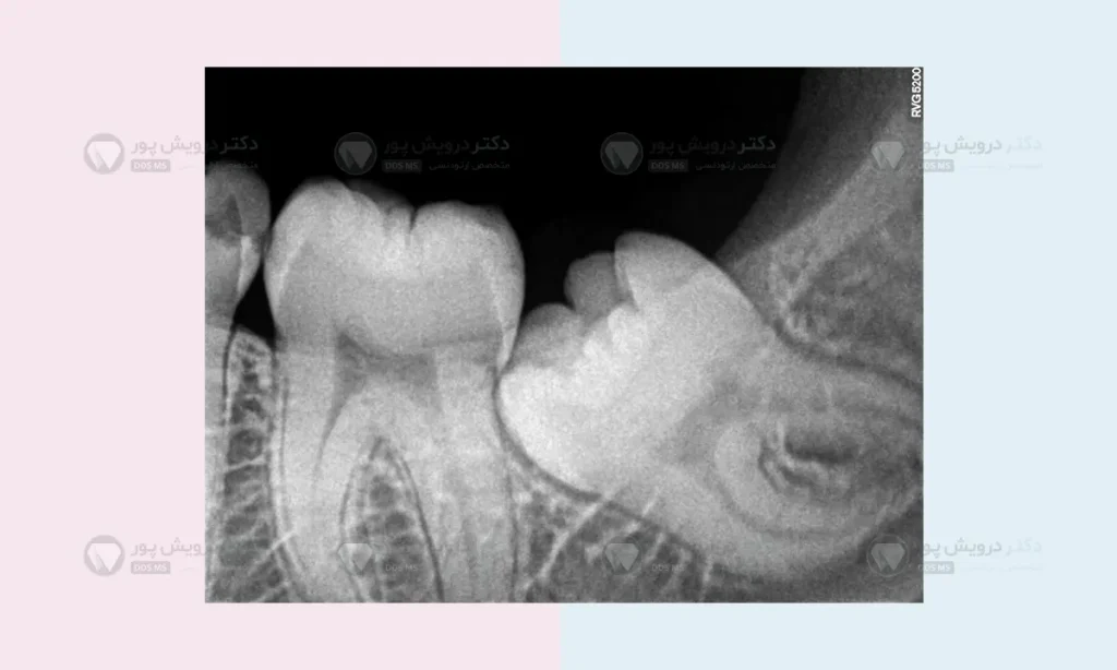 گرافی دندان عقل نهفته