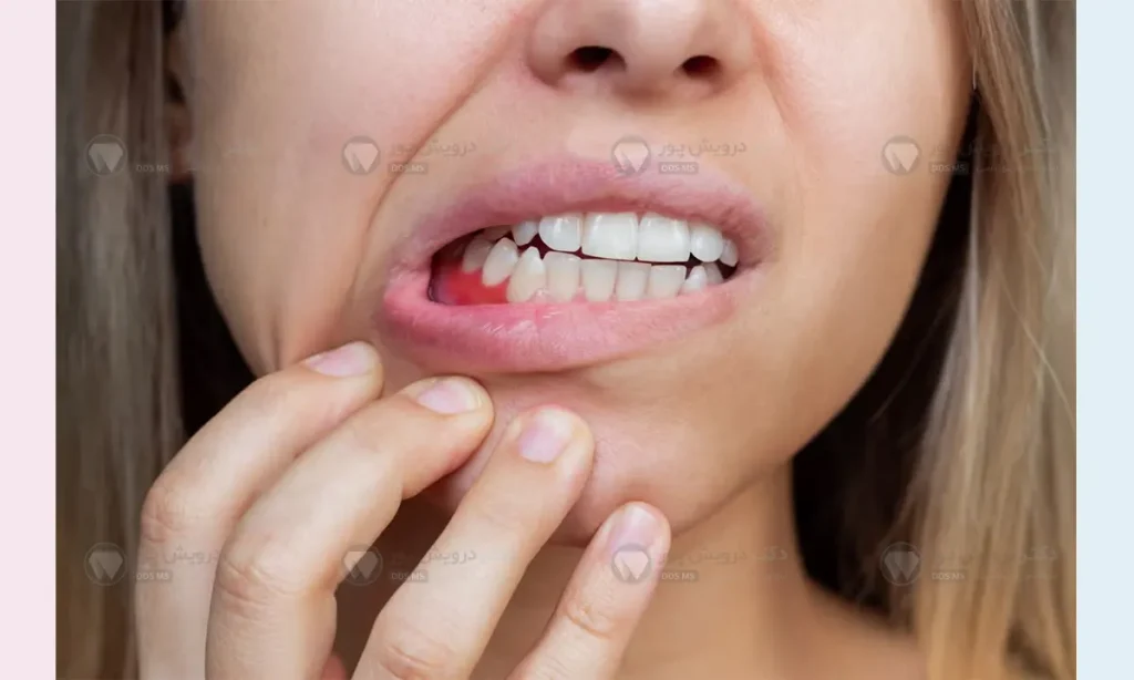ژنژویت بارداری