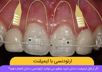 ارتودنسی با ایمپلنت دندان شاخص