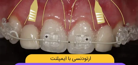 ارتودنسی با ایمپلنت دندان شاخص