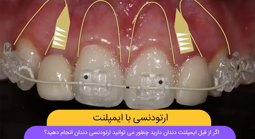 ارتودنسی با ایمپلنت دندان شاخص