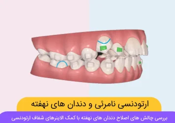 الاینرهای شفاف و دندان های نهفته و نیمه نهفته شاخص