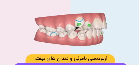 الاینرهای شفاف و دندان های نهفته و نیمه نهفته شاخص