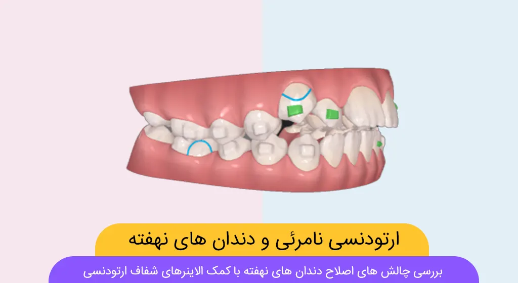 الاینرهای شفاف و دندان های نهفته و نیمه نهفته شاخص