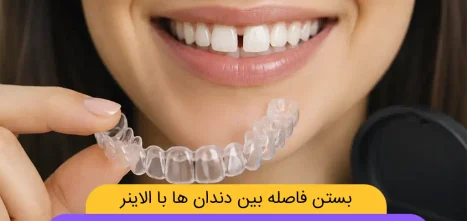 آیا ارتودنسی نامرئی برای بستن فاصله بین دندان ها شاخص