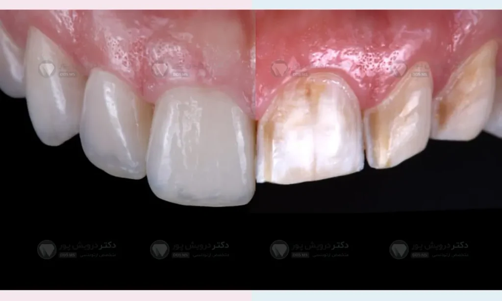 تراش دندان برای لمینت
