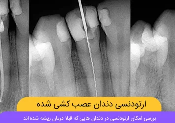 ارتودنسی دندان عصب کشی شده شاخص