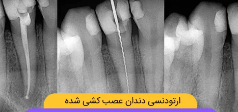 ارتودنسی دندان عصب کشی شده شاخص